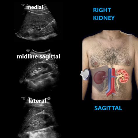 Kidney Ultrasound: Purpose, Procedure & Results.